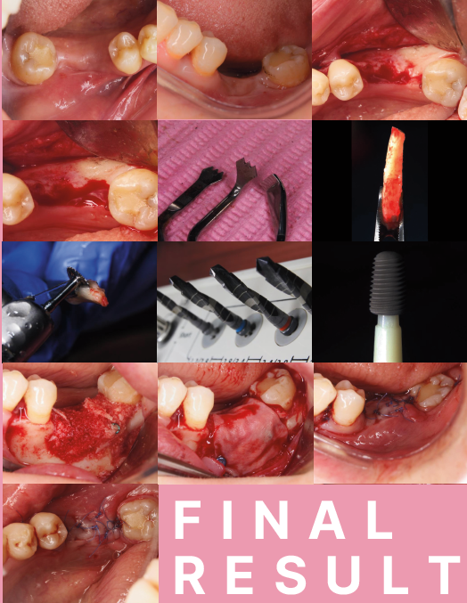 Advanced Dental Implants