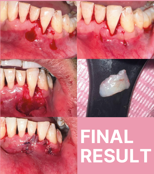 Gingival Recession Treatment